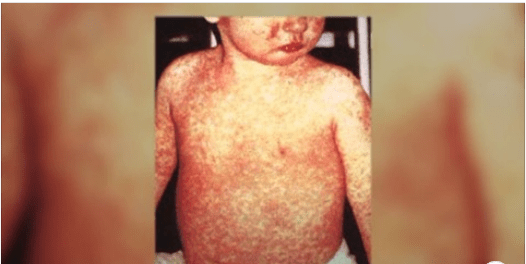 Measles is a highly contagious