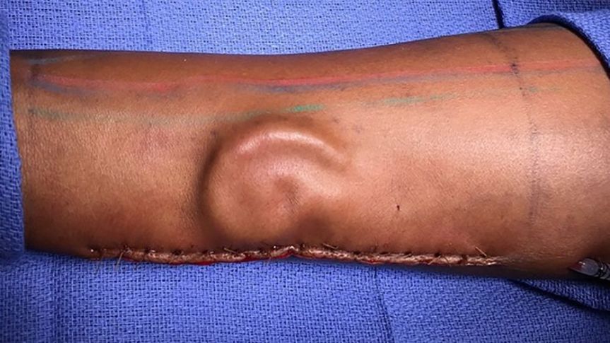Physicians at William Beaumont Army Medical Center reportedly did a total ear reconstruction