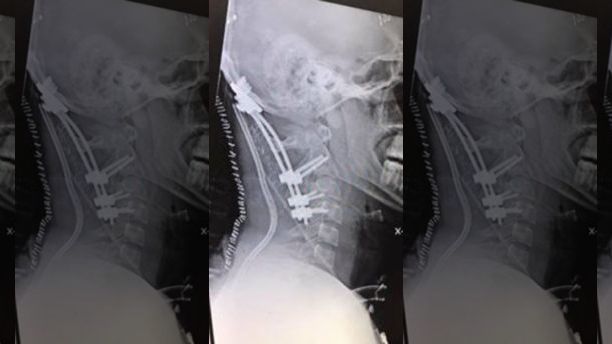 The X-ray of Meister's neck.  (Beacon Health System)
