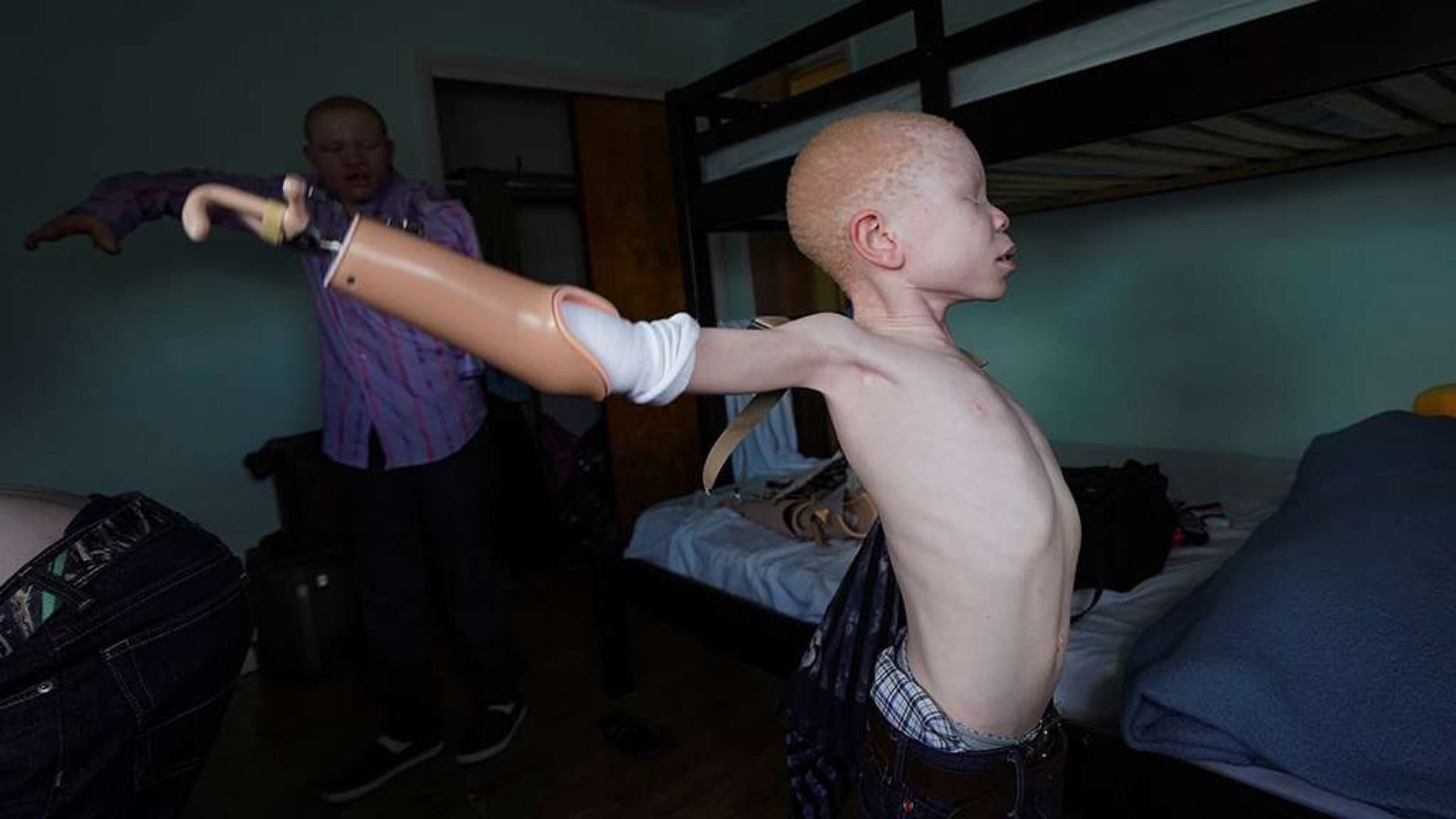 Baraka Lusambo, 7, a Tanzanian with albinism