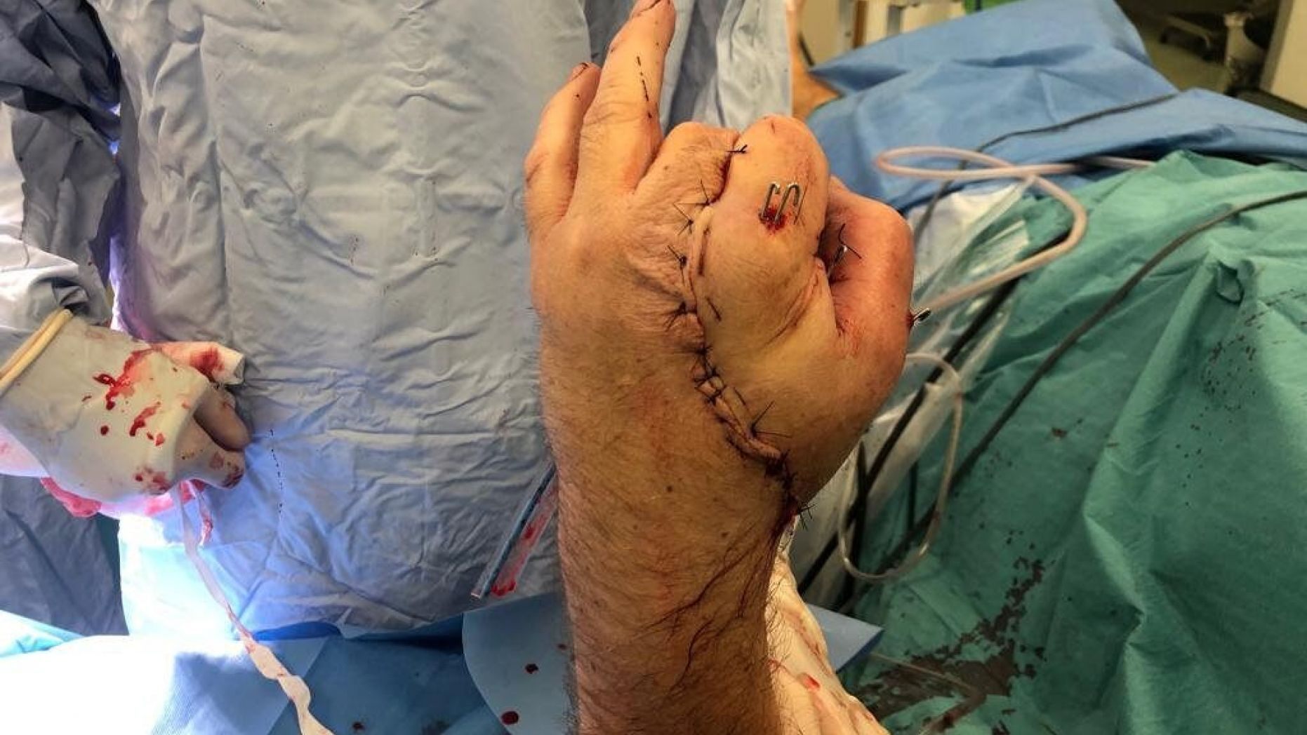 Doctors had to harvest nerve and vein rafts from his foot and forearm but noticed a patch on his palm that was still uncovered. 
