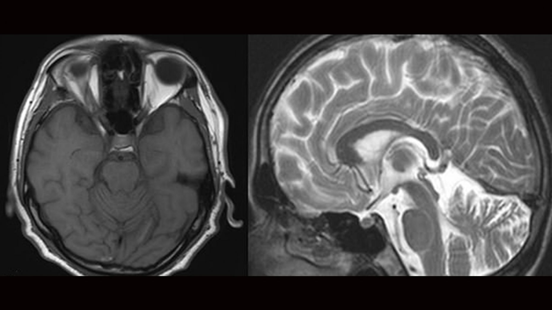 The scan revealed the man had neurosyphilis. 