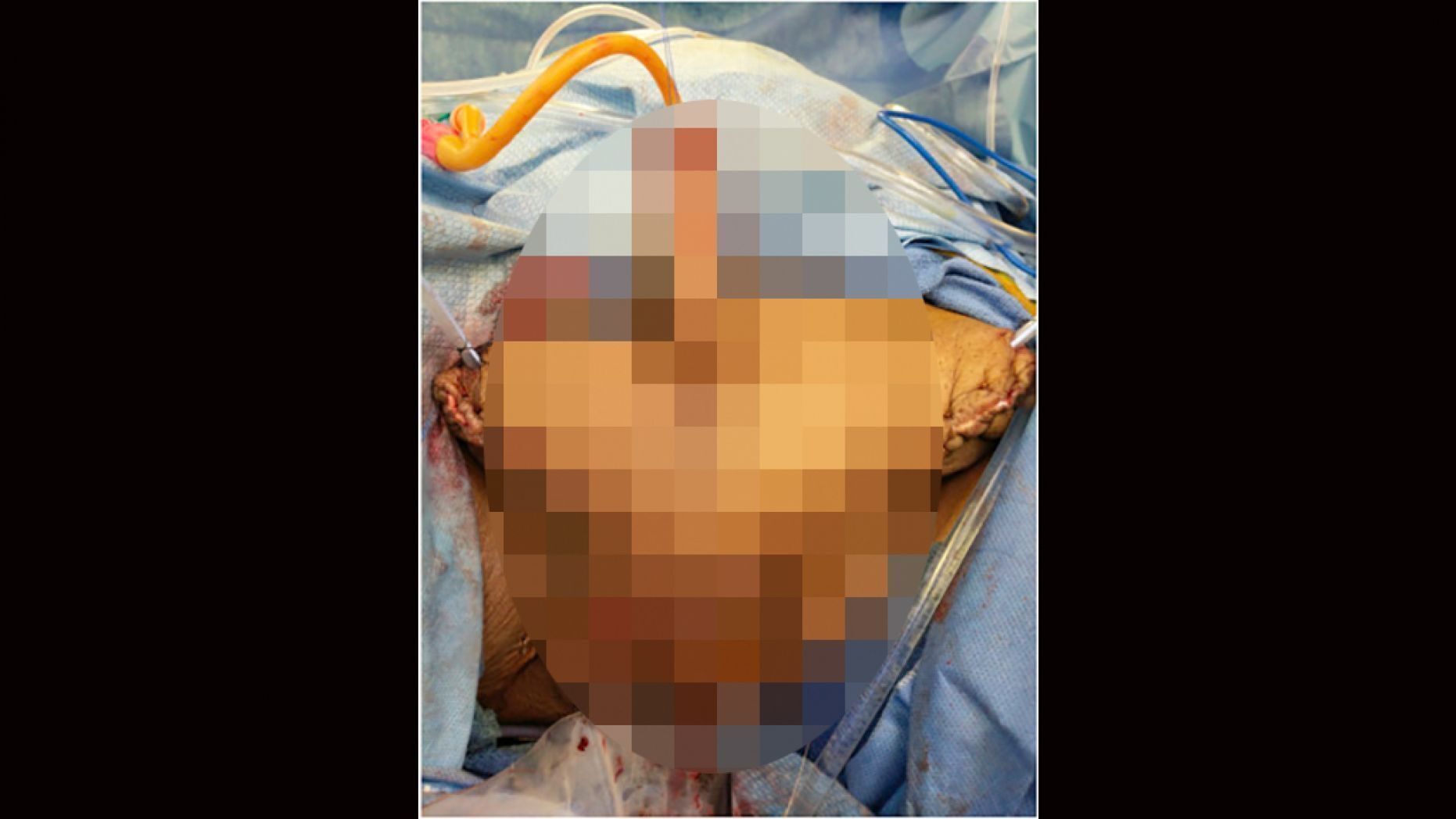 The man had reportedly not seen a doctor in 30 years. (Urology Case Reports)