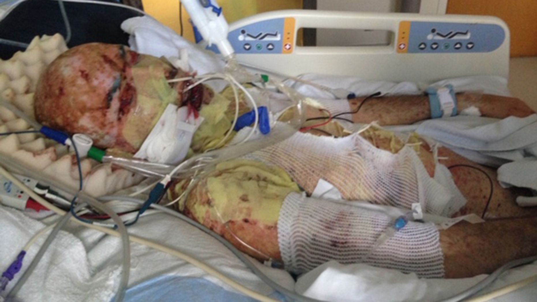 His eyes were sewed shut as he healed to protect his vision.