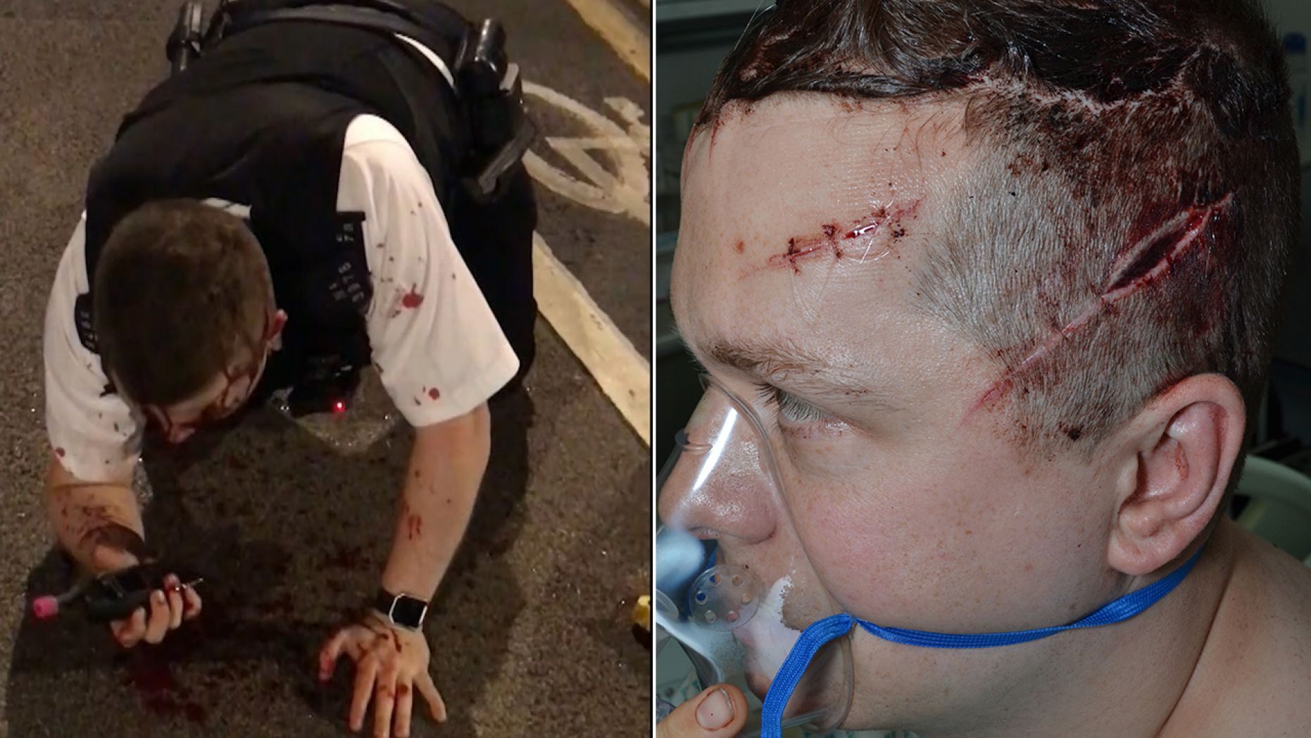 Outten is pictured left after discharging his Taser and stopping Rodwan's assault. He is pictured right following surgery for his multiple injuries. (Metropolitan Police)
