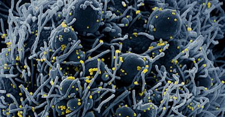 An apoptotic cell (blue) infected by SARS-COV-2 virus (yellow)NIAID