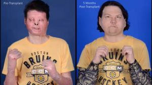 DiMeo, pictured left before the surgery and right in a photo taken last week. (NYU Langone Health)