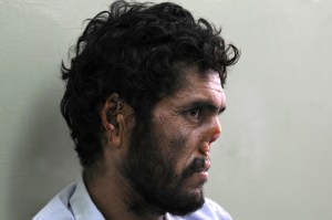 In 2009, Afghan farmer Lal Mohammad said his nose and ears were cut off by the Taliban.
MASSOUD HOSSAINI/AFP via Getty Images