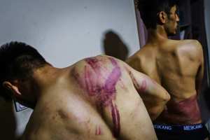 Journalists, Nemat Naqdi, 28, left and Taqi Daryabi, 22, show wounds sustained after Taliban fighters beat them (Marcus Yam/Los Angeles Times/TNS)